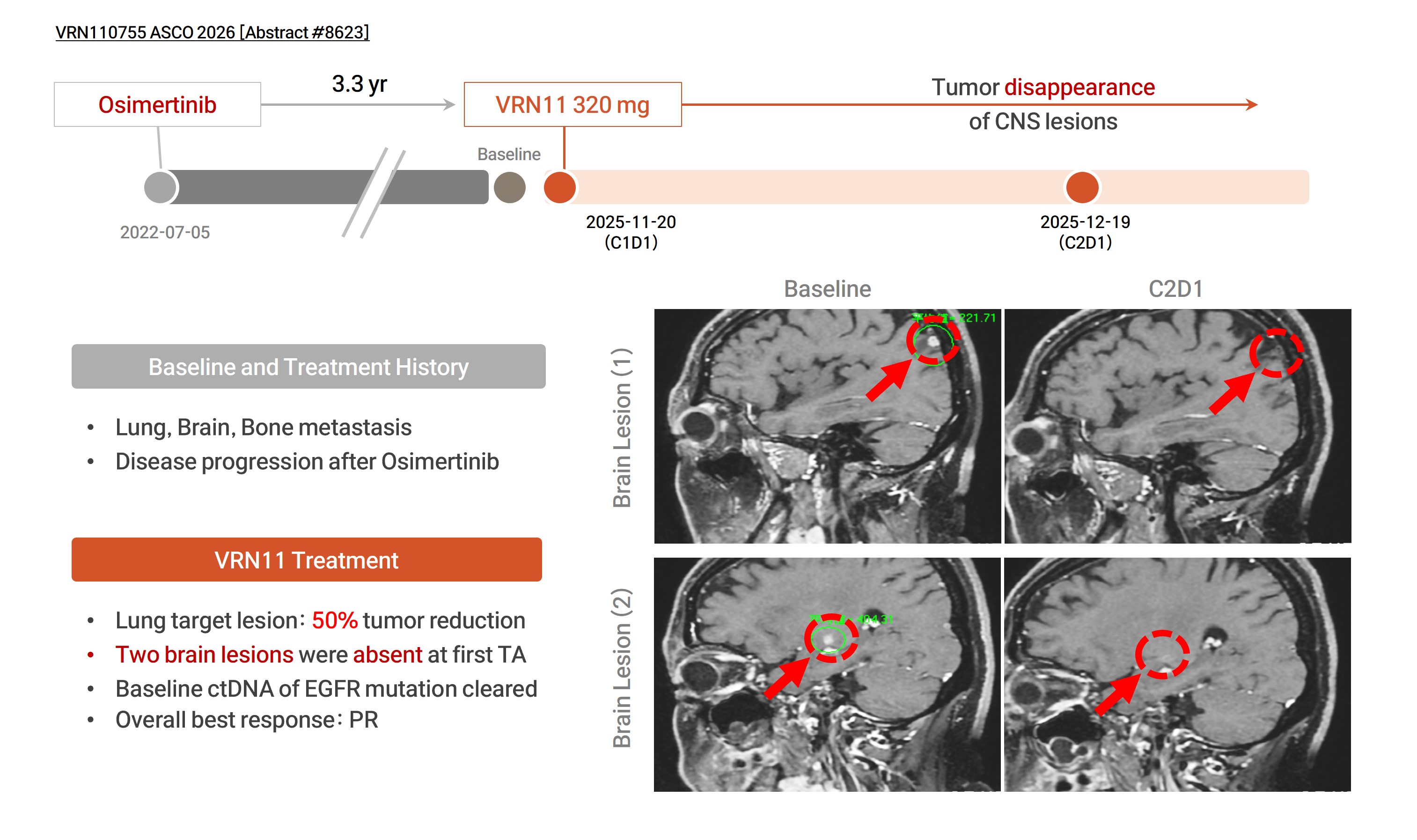 Brain MRI before and after VRN11 in a patient with EGFR Del19/C797S after osimertinib